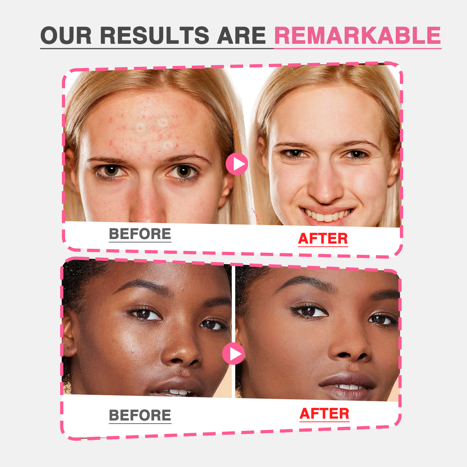 GROEI 18Pcs Microneedle Acne Patches Pimple Invisible Beauty Concealer Blemish Treatment Deep Clean Pores Overnight Recovery